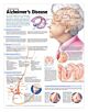 Anatomical Chart Alzheimer's Disease 20 X 26 Inch Heavy Paper Grommets Laminated